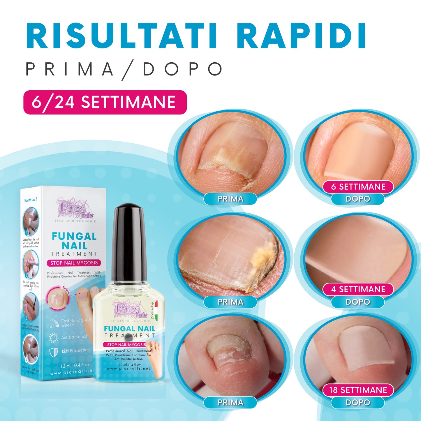 Antimicotico Unghie 12 ml - Trattamento della Micosi Unghie di Mani e Piedi