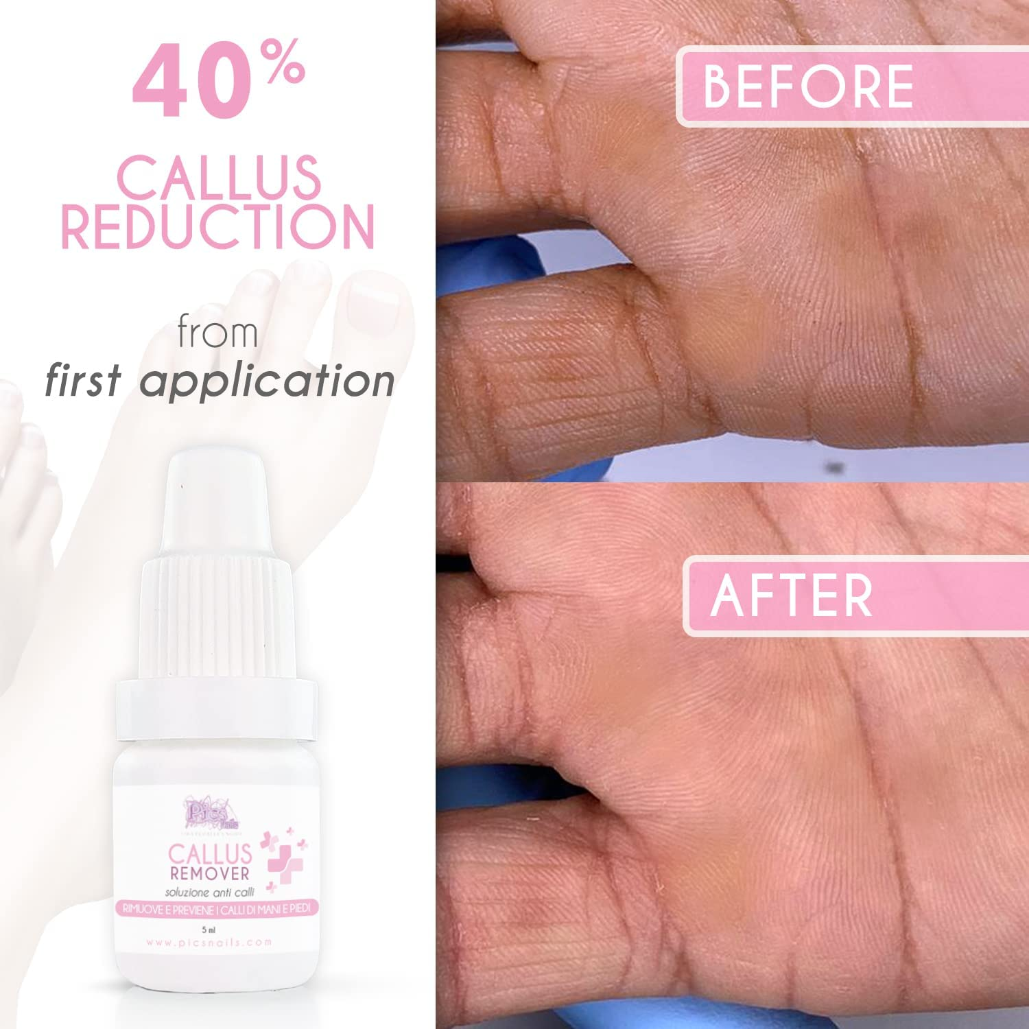 Rimuovi Calli Liquido Strong Professionale 5 Ml - Liquido Callifugo per Piedi E Mani, Rimuove I Calli in Modo Professionale Seguendo Semplici Passaggi