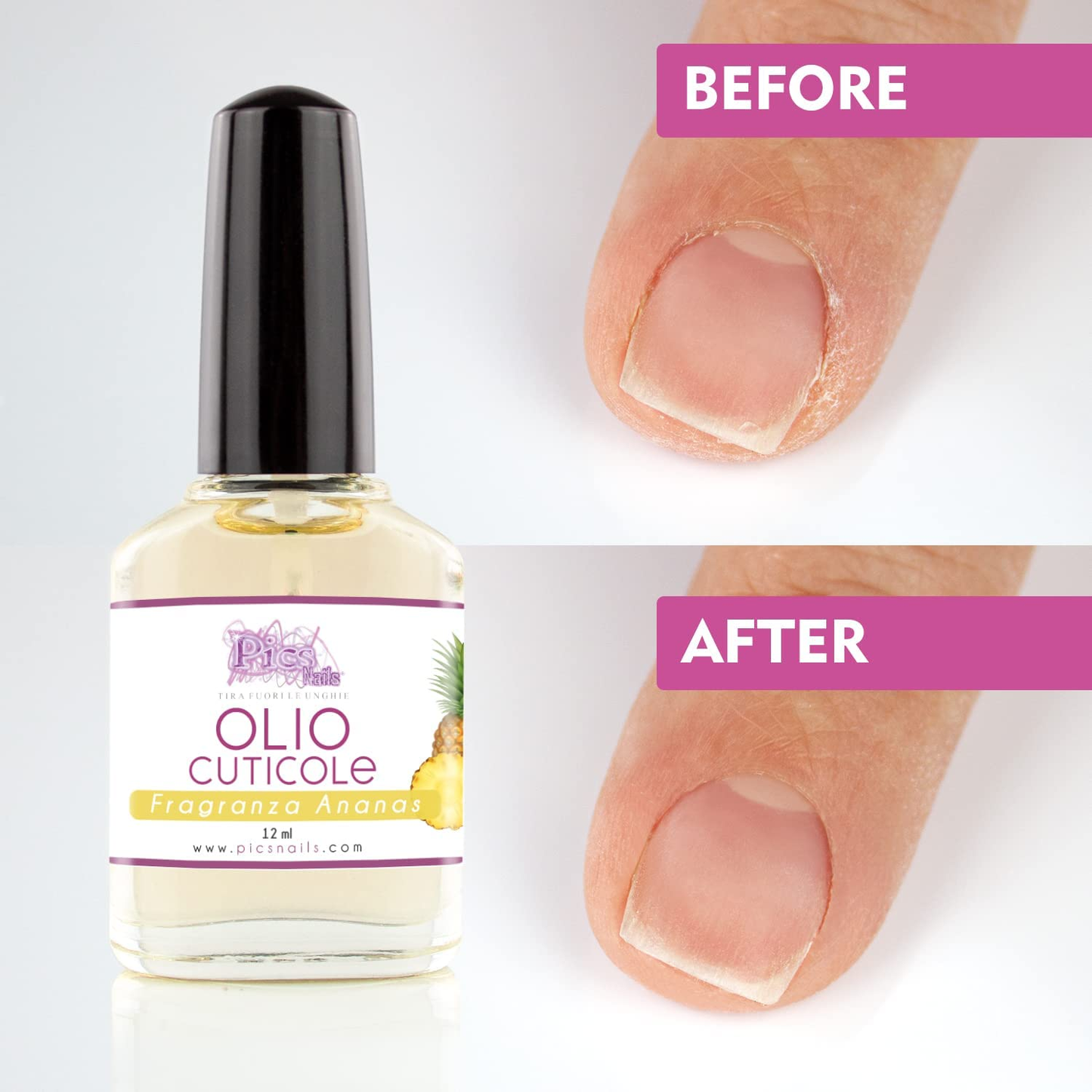 Olio Cuticole Unghie per Mani E Piedi Professionale 12Ml - Fragranza Ananas - Olio Idratante E Rigenerante per Cuticole Di Mani E Piedi, Dona Sollievo E Freschezza Alla Pelle Secca E Irritata