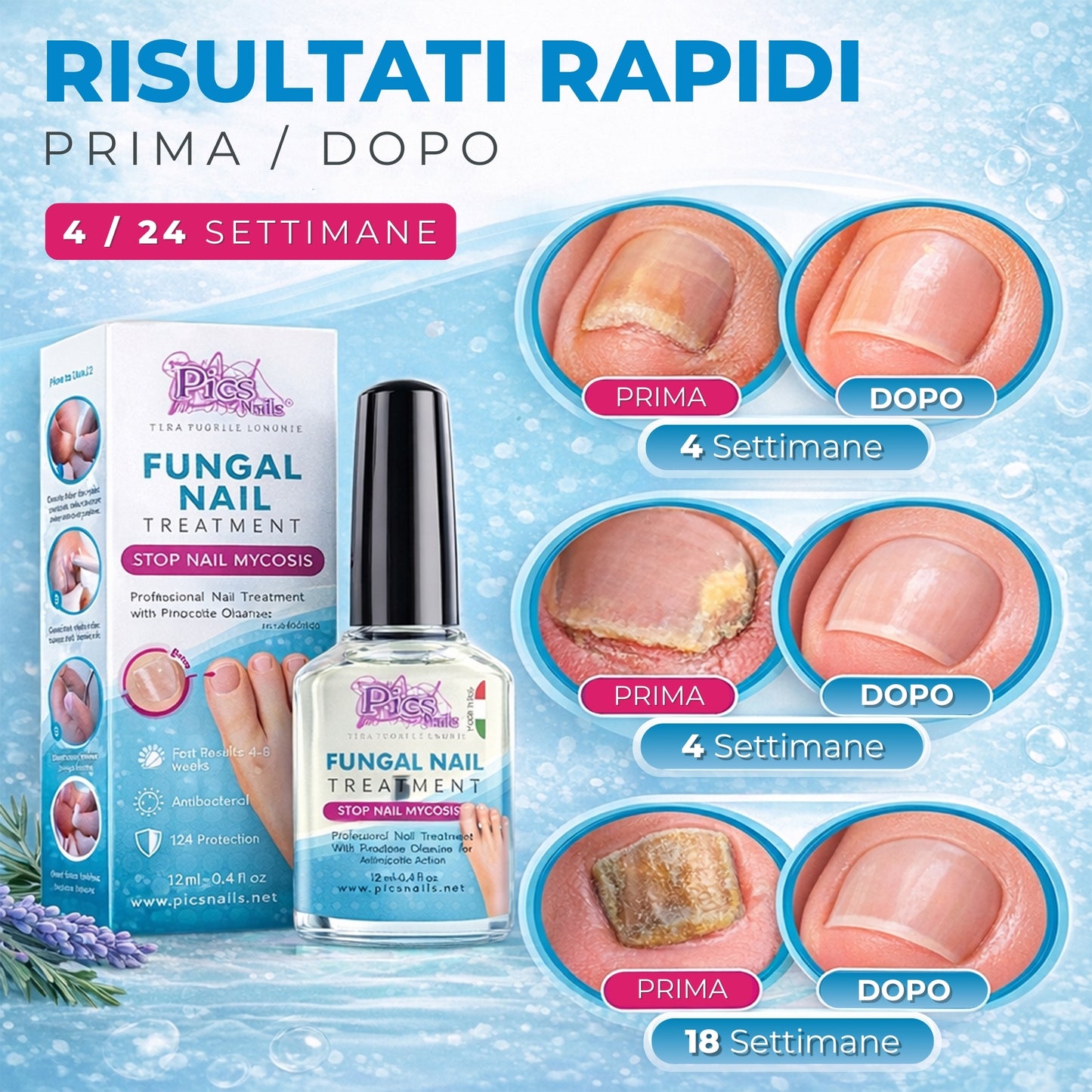 Antimicotico Unghie 12 ml - Trattamento della Micosi Unghie di Mani e Piedi